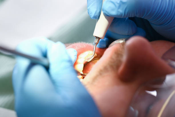 Best Lost Filling or Crown Replacement in Fenton, MO