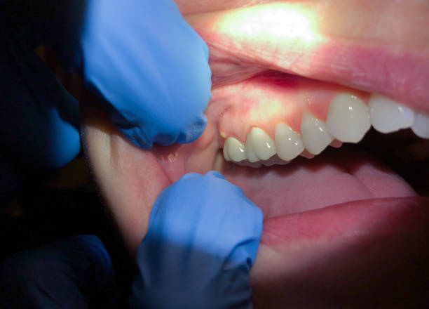 Best Emergency Treatment for Oral Infections in Fenton, MO